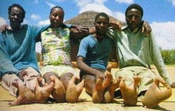 Всего 2 пальца на ногах у нескольких представителей племени Вадомо из Зимбабве и племени Каланга из Ботсваны.