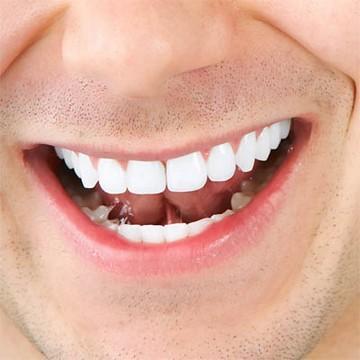 Отбеливание зубов в домашних условиях White Light