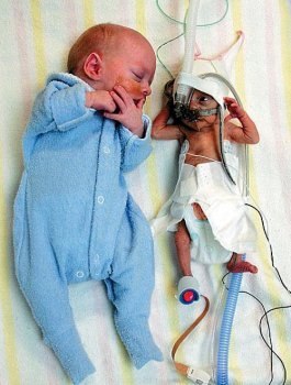В июле 1997г. в брюшной полости 16-летнего Хишама Рагаба из Египта, который жаловался на боль в животе, был обнаружен плод. Раздувшийся мешок, давивший на почки подростка, оказался однояйцовым близнецом Хишама, имевшим размер 18см., и весившим 2кг. Возраст близнеца составлял 32-33 недели.