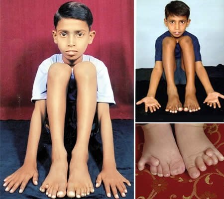 Девендра Харне и Пранамия Менария: Самое большое количество пальцев на руках и ногах