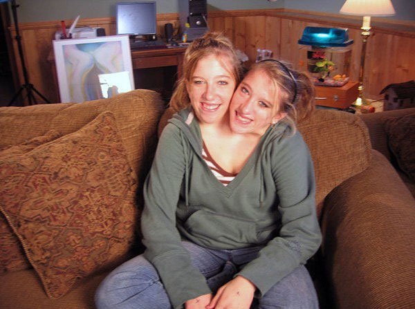 Сросшиеся близнецы – Эбигейл и Бриттани Хенсел, 1990 года рождения, проживающие в США. 