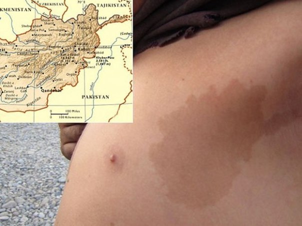 В Афганистане нашелся мальчик с родимым пятном в форме карты страны.