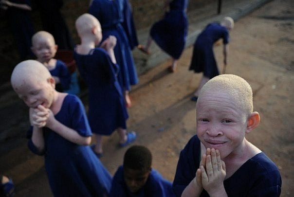 Негритята - альбиносы.