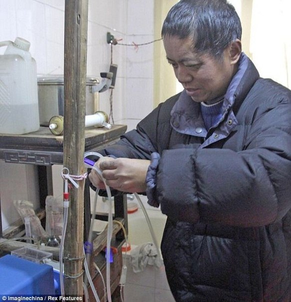 Китайский крестьянин живет 13 лет на самодельной искусственной почке, которую сделал сам.