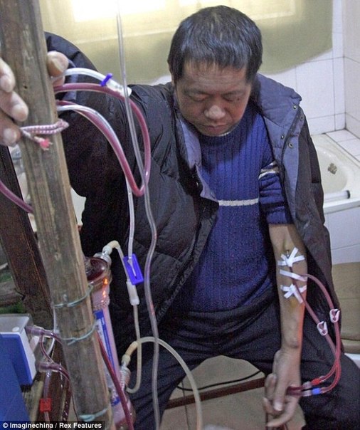 Китайский крестьянин живет 13 лет на самодельной искусственной почке, которую сделал сам.