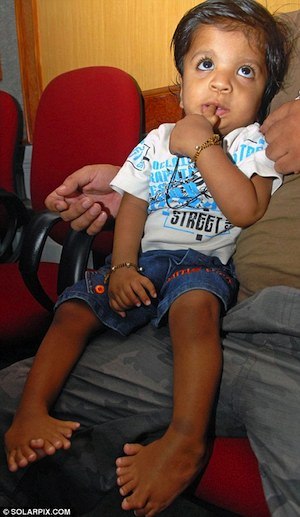 Мировой рекорд побил индийский ребенок, родившийся с 34 пальцами