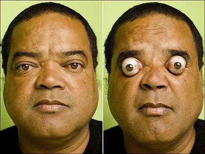 Бразилец Клаудио Пинто способен «вытаращить» глаза на 5 см из глазных орбит.