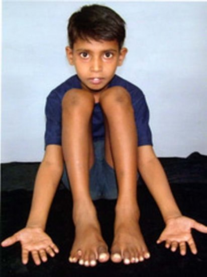 Самое большое количество пальцев на руках и ногах у живого человека оказалось у мальчика из Индии по имени Девендра Харне, у которого 12 пальцев на руках и 13 - на ногах, а в сумме 25 пальцев.