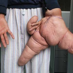 Человек, обладающий самой большой рукой в мире, решился на операцию. 