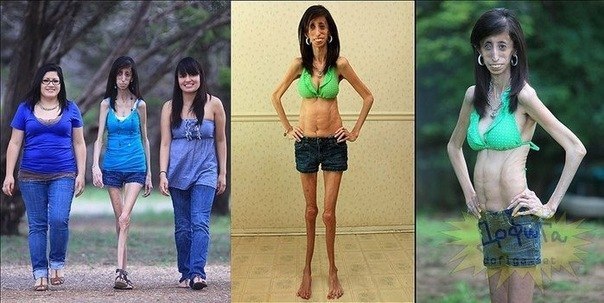 Самая худая женщина в мире весит 25 кг и при это ест 60 раз в день, и не поправляется!