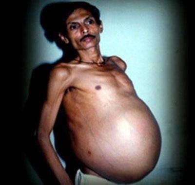 Санджу Бхагад жил с братом-близнецом в желудке.