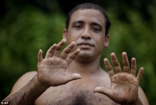 Эрнандес Гарридо: человек с 24 пальцами