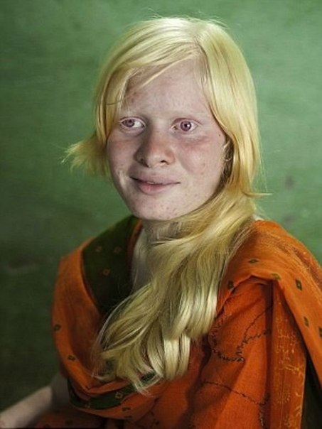 Самая большая семья альбиносов в мире проживает в Индии. Отец семейства Розитурай Пуллан, его жена Мани и шесть их детей все являются чистейшими альбиносами.