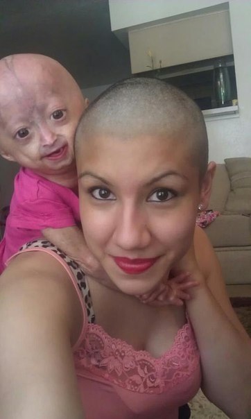 Адалия Роуз со своей 5-летней дочерью страдающей синдромом Хатчинсона-Гилфорда (детская прогерия). США, 2012 год.