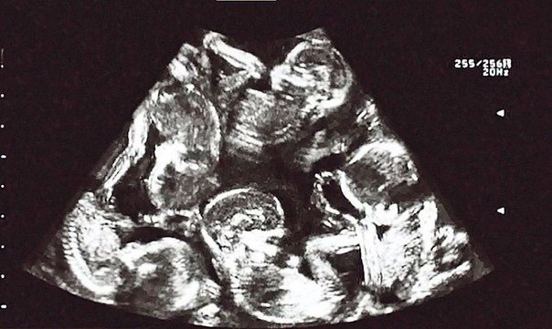 23-летняя чешка Александра Кинова родила пятерых близнецов. Это первый в стране известный случай с рождением такого количества детей. Состояние матери и новорожденных врачи оценивают как хорошее. 