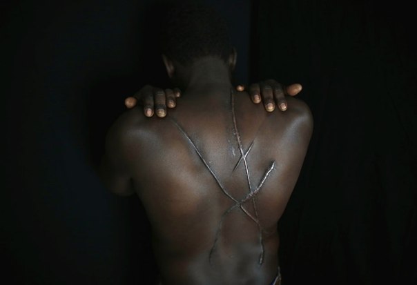 Мигрант из Судана показывает шрамы, оставшиеся после избиения греческими националистами в Афинах.